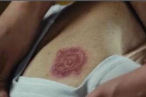 《龙岭迷窟》胡八一三人身上的红斑到底是什么？