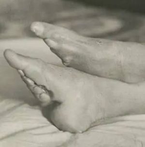 女人裹脚的废除：一段历史的转变